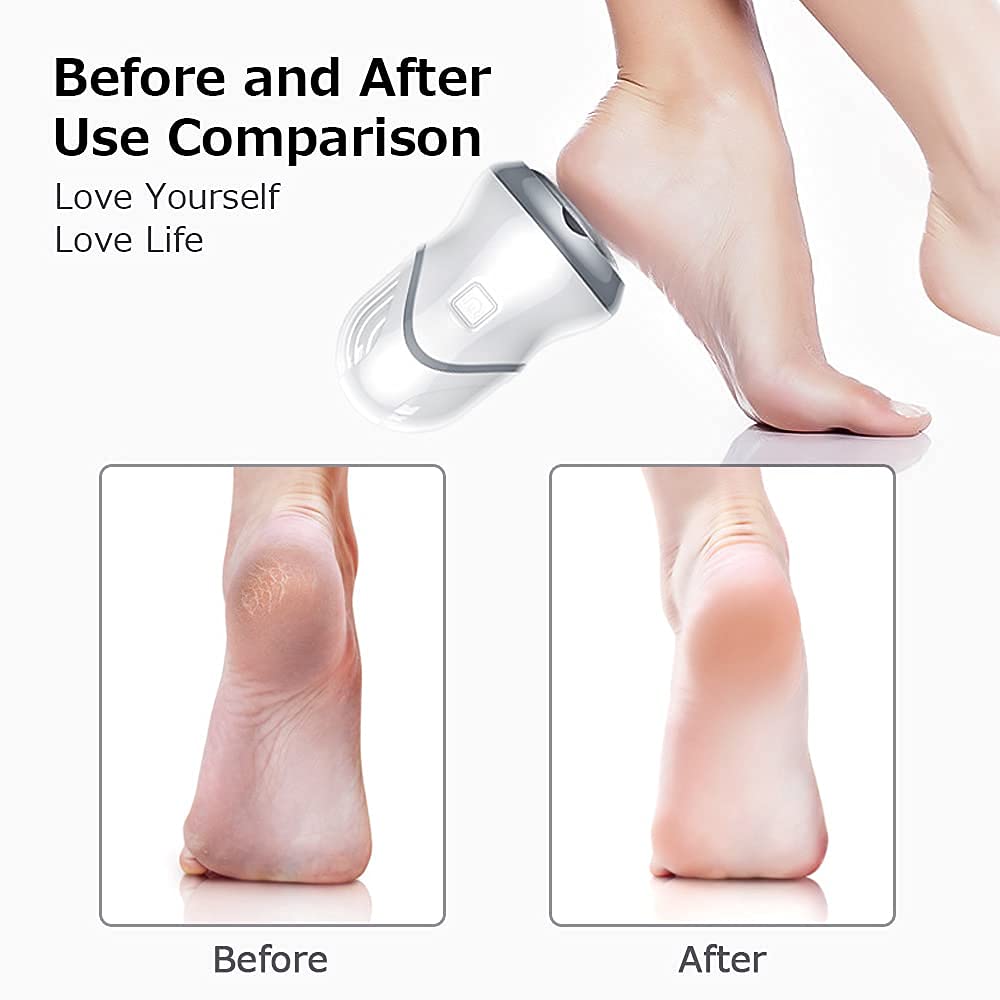 MAYCREATE Callus Remover for Foot Care featuring 2000 rpm Micro Abrasion and Built in Vacuum | USB Rechargeable 500mAh Battery