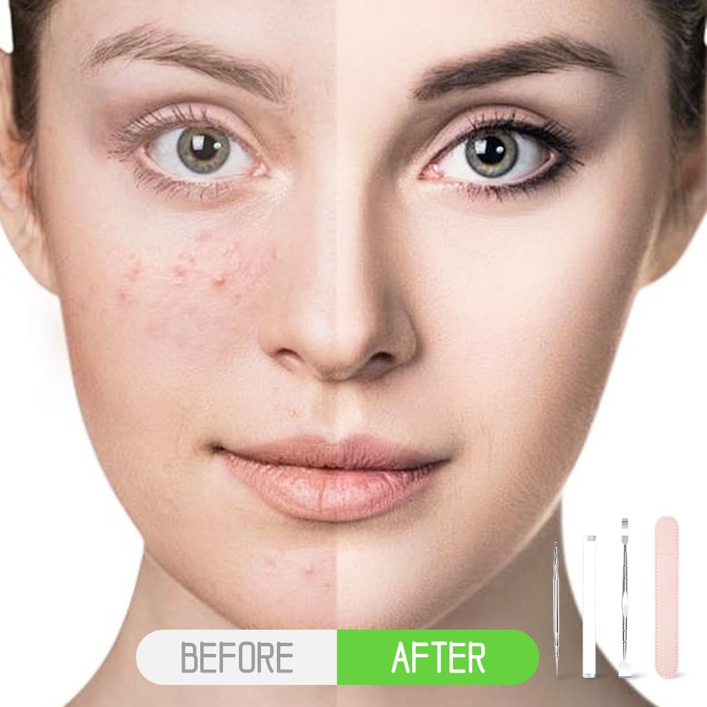 MAYCREATE Stainless Steel Comedone Extractor & Dual Head Blackhead Removal Shovel Pore Cleaning Tools Beauty Tools Facial Cleaning Tools for Acne, Whitehead Popping, Comedone