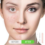MAYCREATE Pimple Remover Tool for Deep Pore Cleansing with Dual Head Extractor & Stainless Steel
