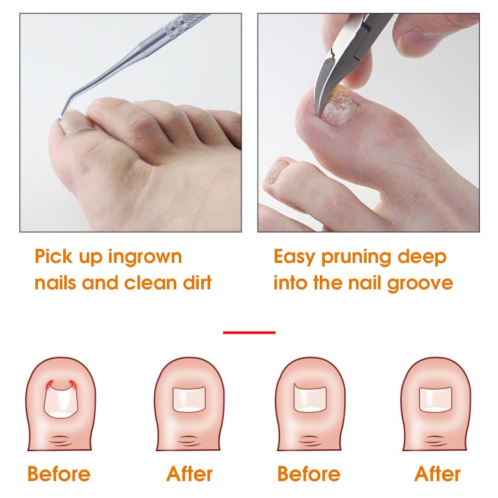 MAYCREATE Ingrown Toenail Clippers for Thick Nails with Curved Blade and 6pcs Stainless Steel Kit | Ergonomic Wide Jaw Design