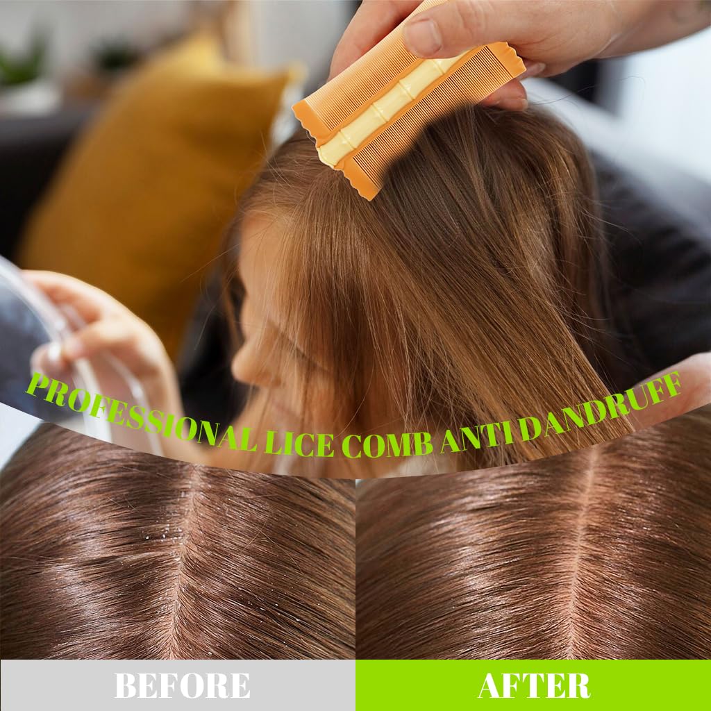 MAYCREATE Lice And Nits Removal Comb 3Pcs for Women and Kids with Double-Sided Fine Teeth | Dandruff and Flea Care